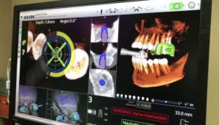 Công nghệ định vị phẫu thuật Navident – Phương pháp cấy Implant không đau