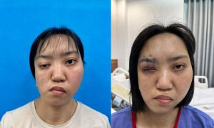 ca phẫu thuật chỉnh hình cho bạn diễn ra thành công mỹ mãn