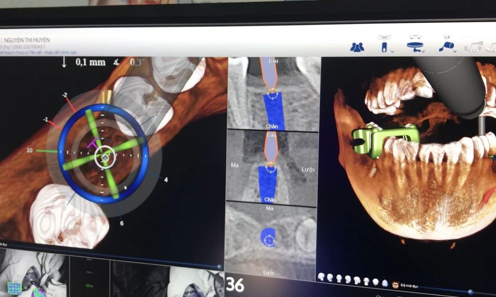 Với Navident, bác sĩ có khả năng tiếp cận các vùng khó tiếp cận một cách an toàn và chính xác hơn