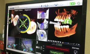 Công nghệ định vị phẫu thuật Navident – Phương pháp cấy Implant không đau